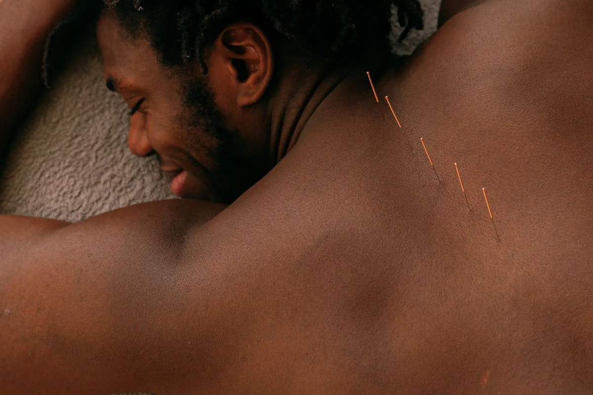 Relaxed man receiving acupuncture on his back to ease anxiety and stress