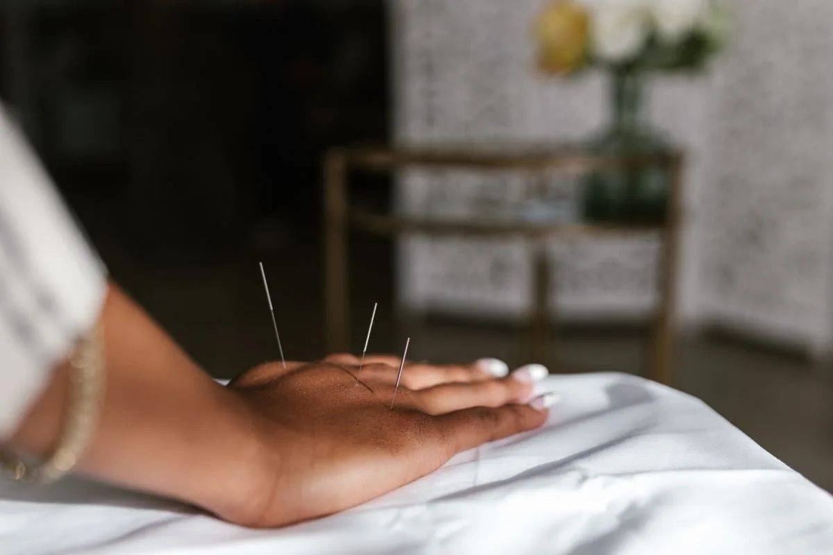 Acupuncture needles placed in the hand during a relaxing session for the nerves